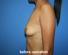 plastic-surgery-breast-augmentation